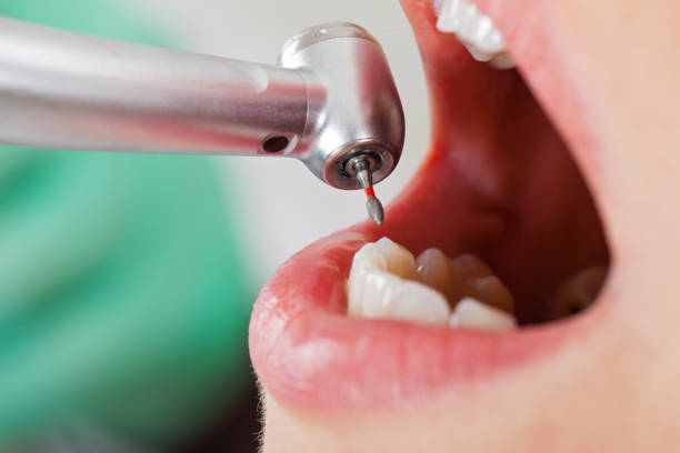 Best Emergency Dentist for Knocked-Out Tooth in Bristol, VA